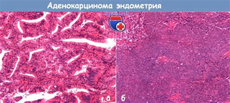 Аденокарцинома: основная информация