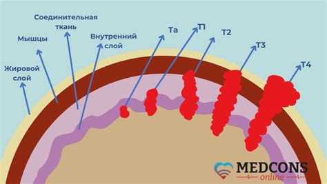 Альтернативные методы лечения мочевого пузыря