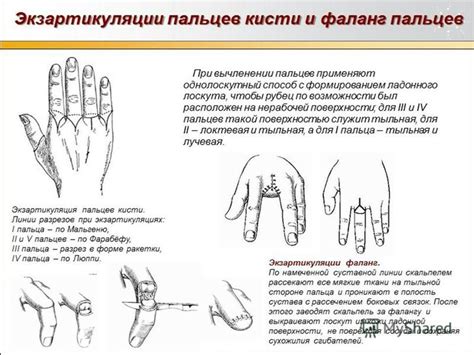 Ампутация конечностей и ее последствия