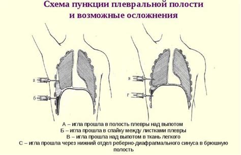 Анатомическое расположение плевральной полости