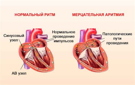 Аритмия сердца