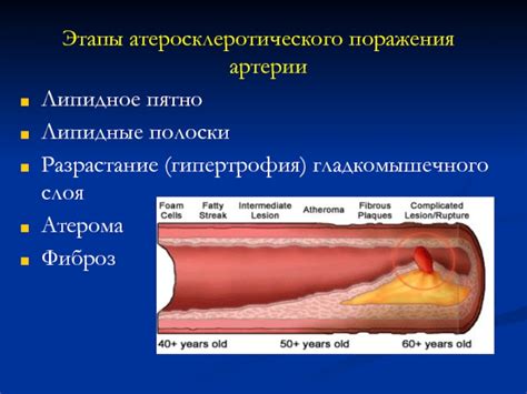 Атеросклеротические изменения восходящего отдела аорты