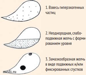 Билиарный сладж у ребенка