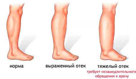 Болезненные отеки конечностей