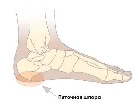 Боль в пятке: основные симптомы пяточной шпоры