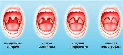 Важность диагностики при сне с белыми червями в горле