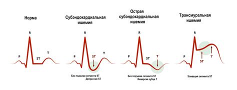 Важность и особенности ЭКГ без ноги