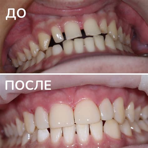 Важность композитного протокола в стоматологии