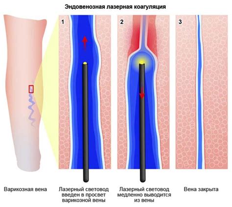 Важность скрининга вен нижних конечностей