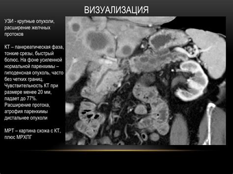 Важные факты о канцероматозе брюшины при раке яичников