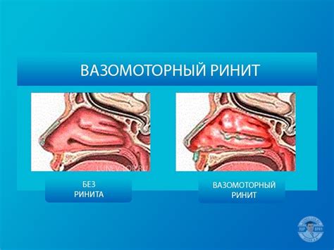 Вазомоторный ринит