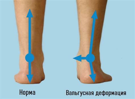 Вальгусная деформация у детей: причины и последствия