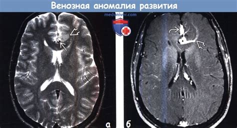 Венозная аномалия развития головного мозга