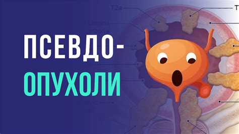 Верхняя часть мочевого пузыря