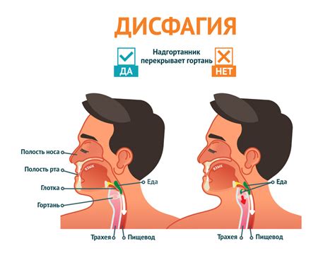 Взрослая дисфагия: симптомы и проявления