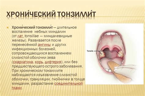 Виды и стадии тонзиллита