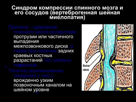 Виды компрессии корешков спинного мозга