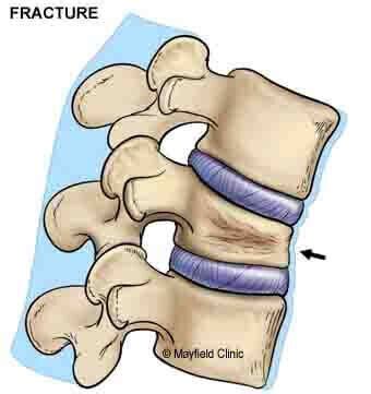 Виды переломов позвоночника