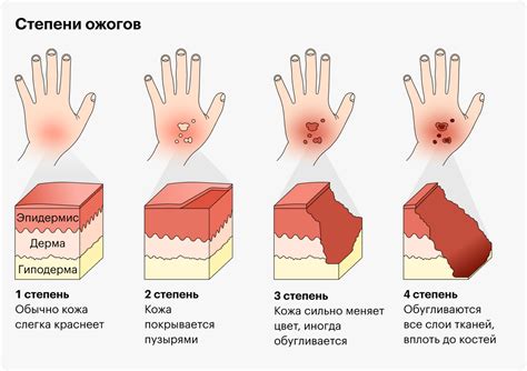 Виды шрамов после ожога