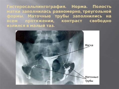 Влияние варикоцеле на проходимость маточных труб: что говорят исследования