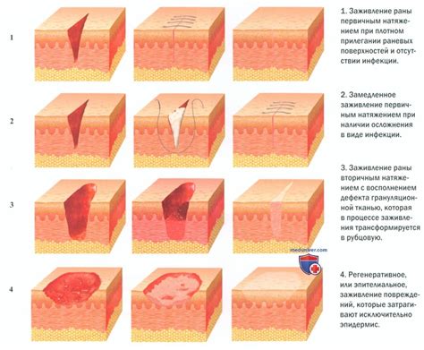 Влияние медицинских препаратов на заживление раны