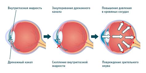 Влияние сахарного диабета на глазное давление