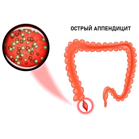 Воздействие острого пищи