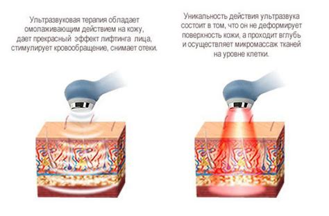 Воздействие ультразвуковой терапии на организм