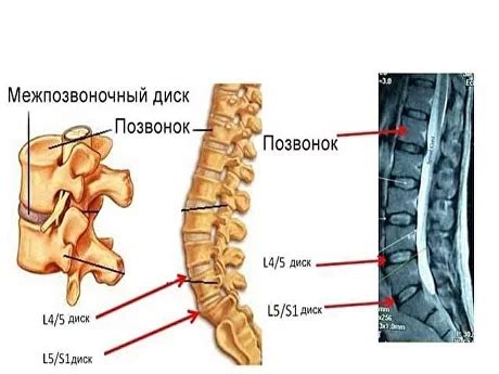 Возможные оперативные методы для лечения пролапса диска L5-S1