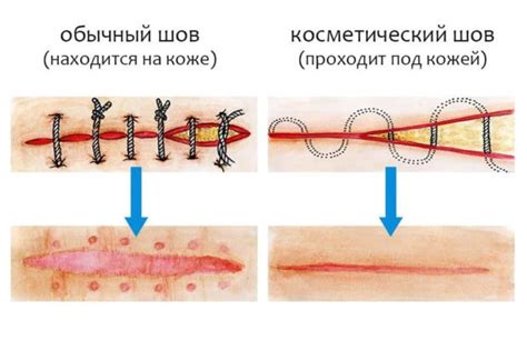 Возможные осложнения в процессе удаления швов