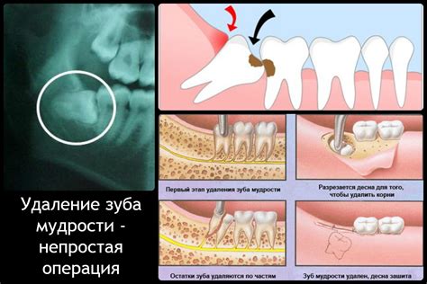 Возможные осложнения и риски при удалении лопаток