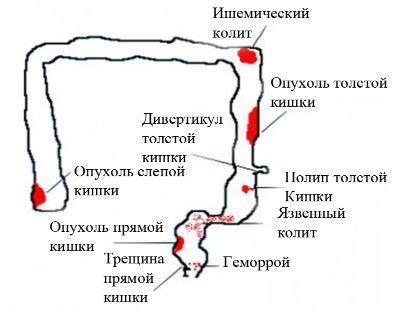 Возможные патологии, связанные с отрицательным уробилиногеном в кале