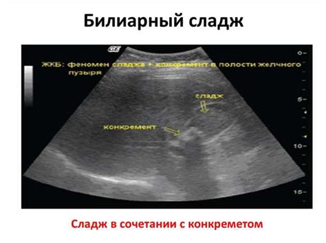 Возможные последствия анэхогенного просвета в желчном пузыре