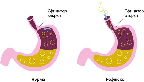 Возможные причины изжоги и их решение