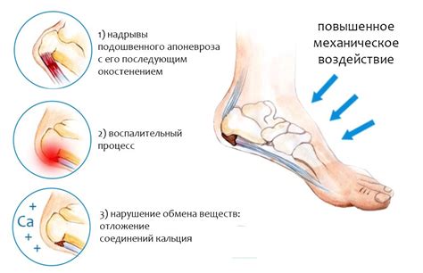 Возможные симптомы и диагностика шпоры на пятке