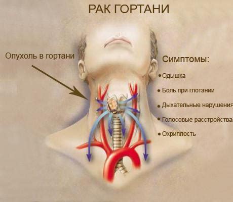 Воспаление гортани и горла