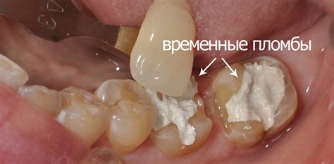 Временная пломба необходима после лечения зуба