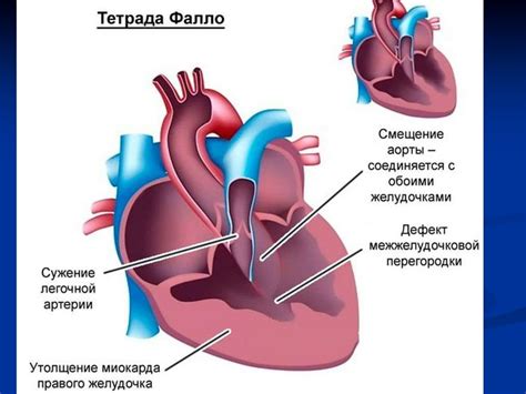 Врожденные аномалии сердечной перегородки