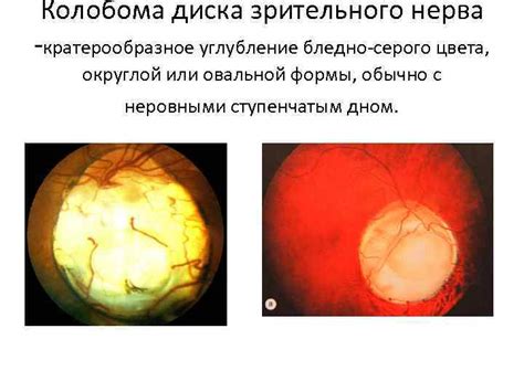 Врожденные аномалии структуры глаза