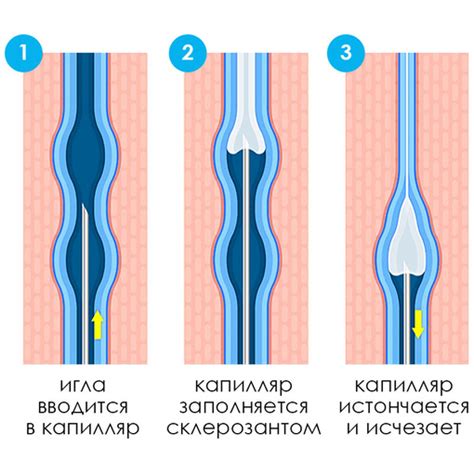 Второй способ: склеротерапия для исчезновения сосудистых звездочек