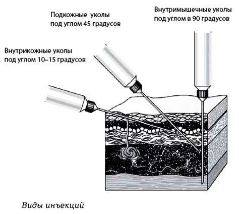 Выбор шприца для инъекции