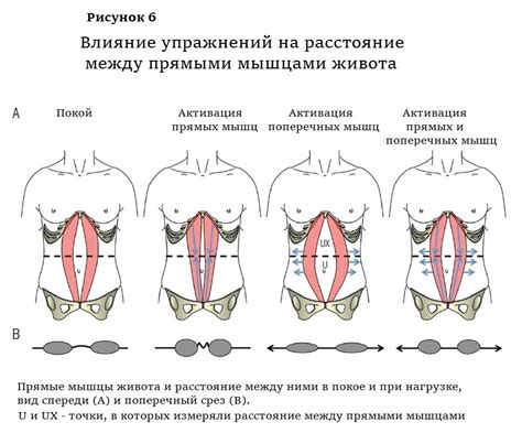 В чем заключается диастаз брюшных мышц и как он возникает