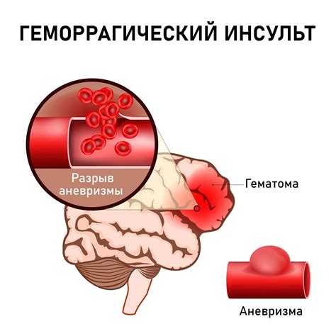 Геморрагический инсульт