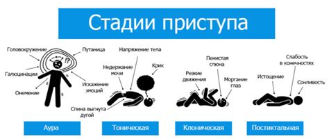 Генерализованные приступы: особенности