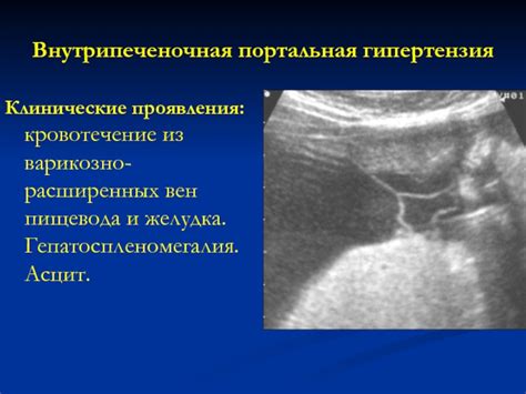 Гепатоспленомегалия и портальная гипертензия