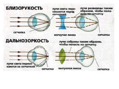 Гиперметропия 1 степени: особенности и лечение