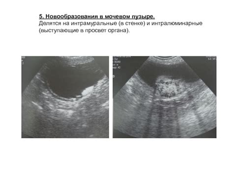 Гиперэхогенная взвесь в мочевом пузыре