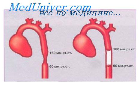 Гипоплазия перешейка аорты