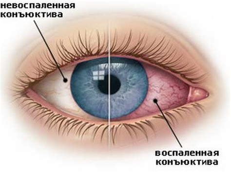 Глазные симптомы аллергии