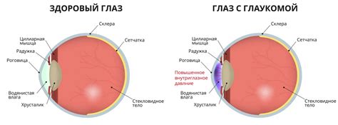 Глаукома